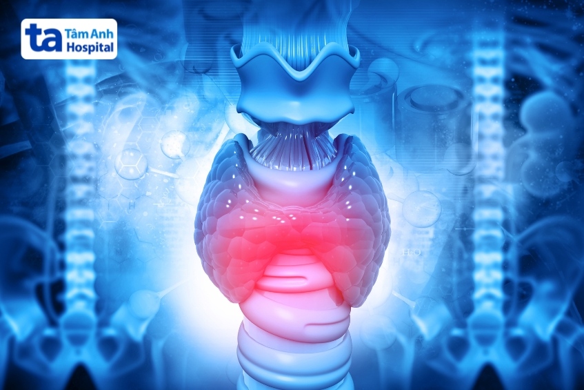 viêm giáp de quervain là tình trạng viêm bán cấp tuyến giáp