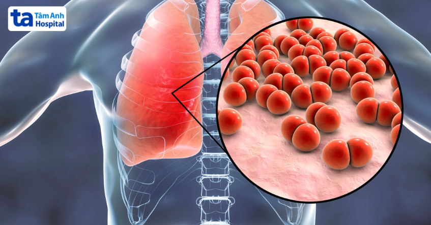 Mô phỏng phổi bị viêm do vi khuẩn gram âm gây nhiễm trùng, minh họa tác dụng của Aztreonam