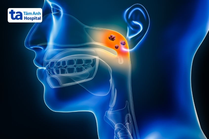 viêm tuyến giáp cấp thường xuất hiện sau nhiễm trùng đường hô hấp