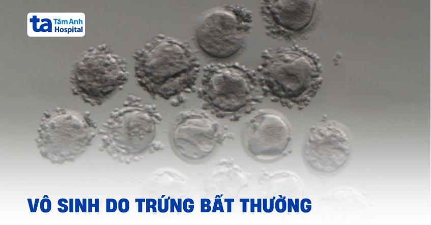Vô sinh do 100% trứng móp méo bất thường
