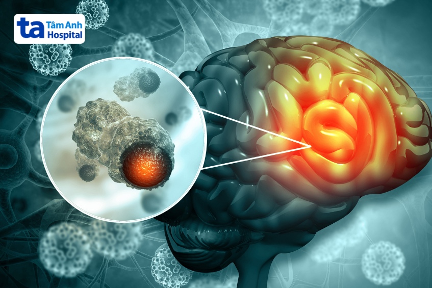 với ung thư não, xạ trị có thể được dùng đơn lẻ hoặc kết hợp với phẫu thuật, hóa trị… tùy thuộc vào loại và giai đoạn bệnh