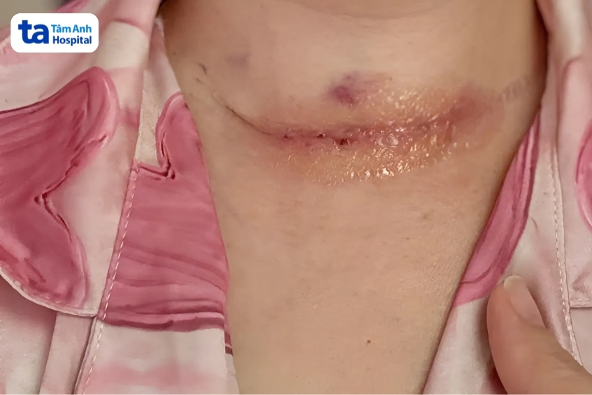 với vết mổ đang lành thương, người bệnh cần lưu ý giữ vệ sinh kỹ