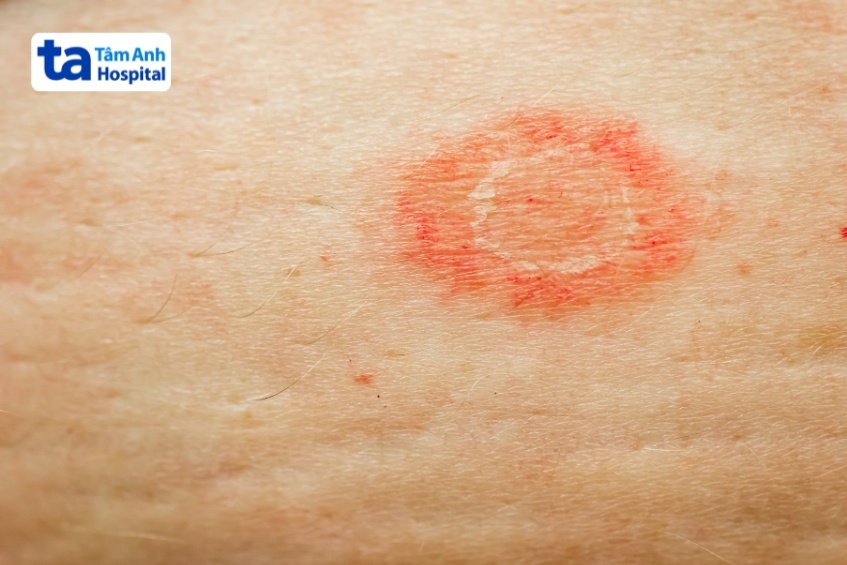 vòng tròn đỏ trên da ngứa xuất hiện thế nào