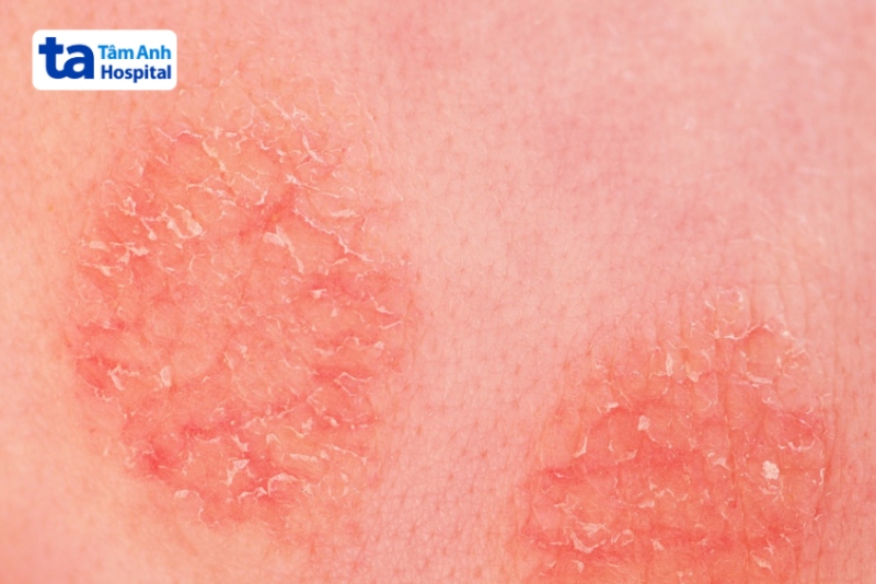 vùng da bị lichen hóa