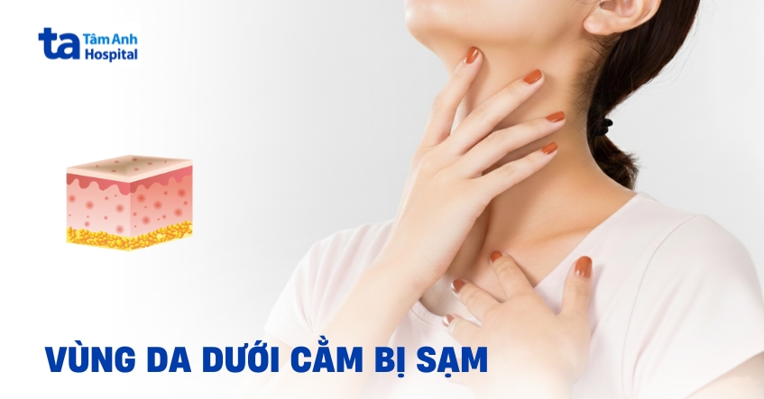 Biện pháp giúp vùng da dưới cằm bị sạm đều màu trở lại