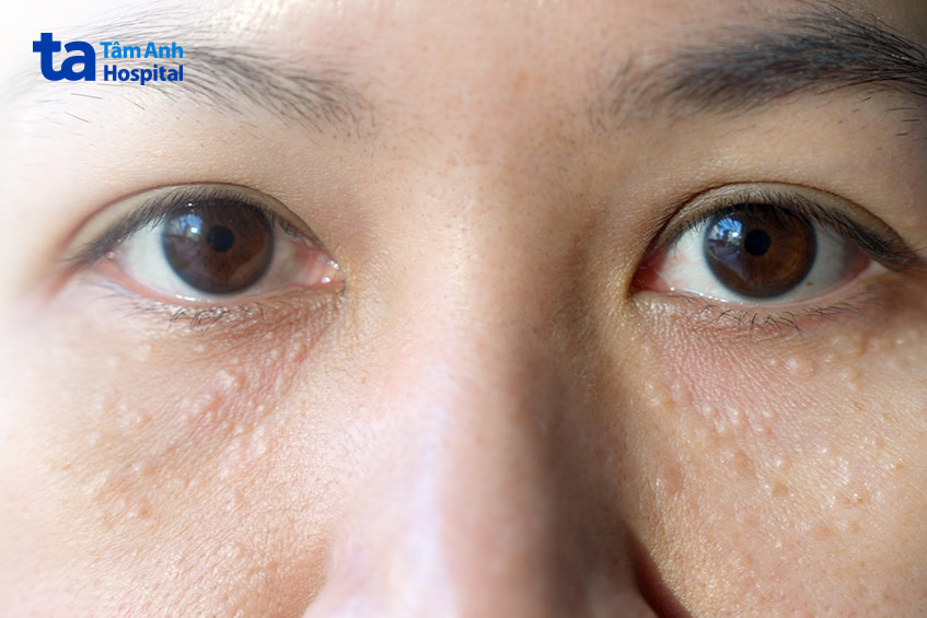 Vùng da dưới mắt có nhiều nốt trắng nhỏ li ti nghi do u tuyến mồ hôi