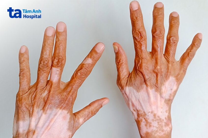 vùng da tay bị mất sắc tố