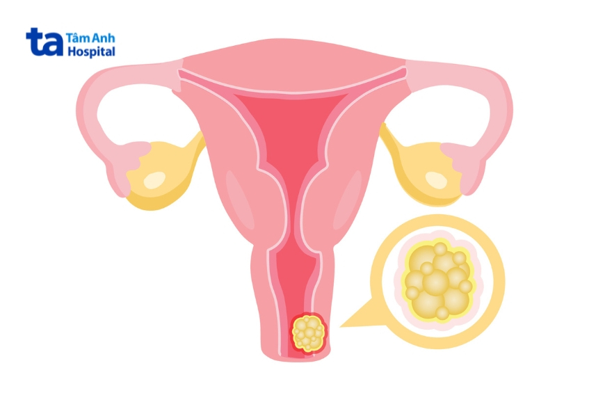 xạ trị áp sát cổ tử cung được chỉ định từ giai đoạn ib2