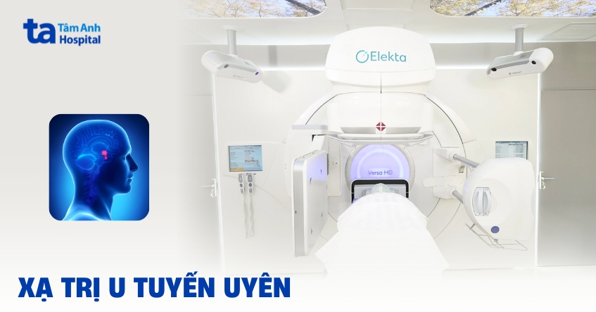 Kỹ thuật xạ trị điều trị u tuyến yên ác tính