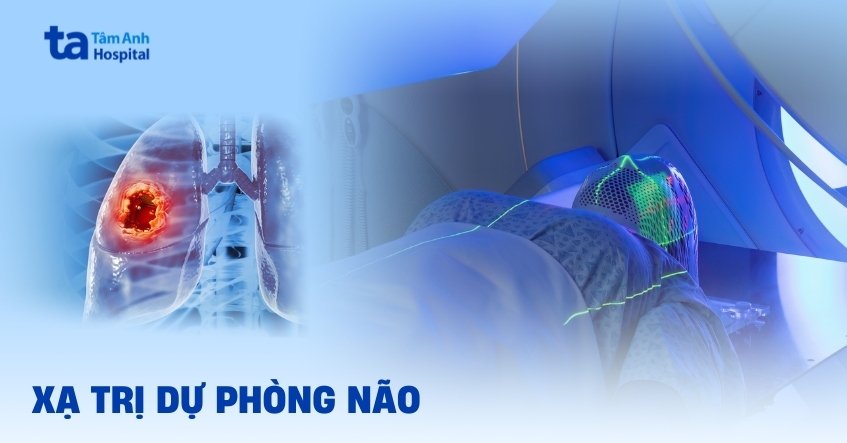 Xạ trị dự phòng não cho bệnh nhân ung thư phổi giai đoạn tiến triển