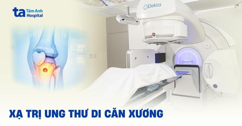 Xạ trị giảm đau ung thư di căn xương bằng phương pháp nào?