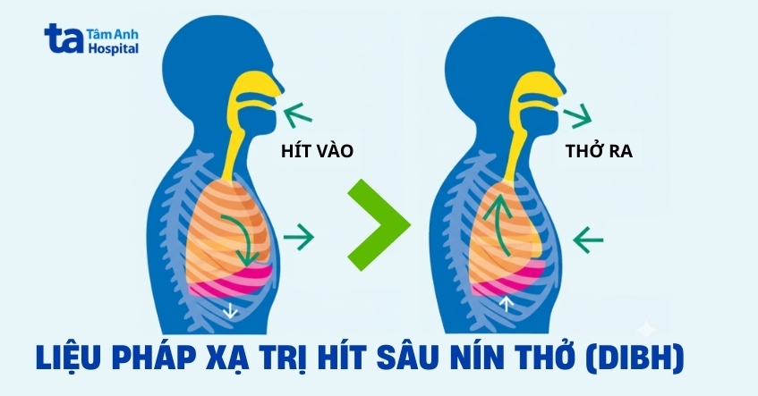 Liệu pháp xạ trị hít sâu nín thở (DIBH)