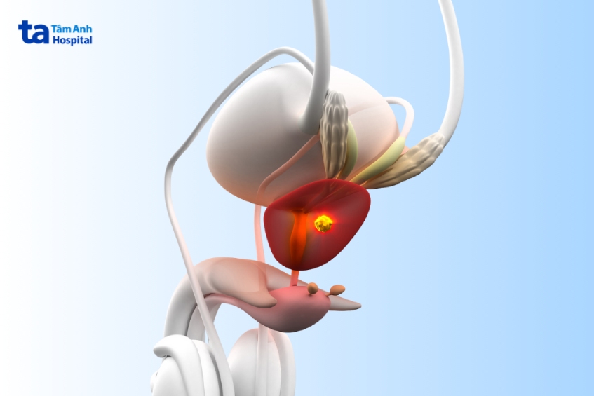 xạ trị là phương pháp hiệu quả điều trị ung thư tuyến tiền liệt