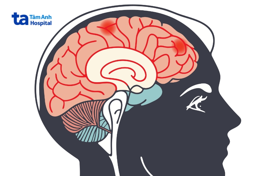 xạ trị u não giúp tiêu diệt chính xác tế bào ung thư, giảm triệu chứng và bảo tồn tối đa chức năng não