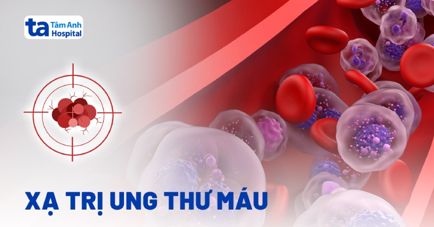 Xạ trị ung thư máu có được không?