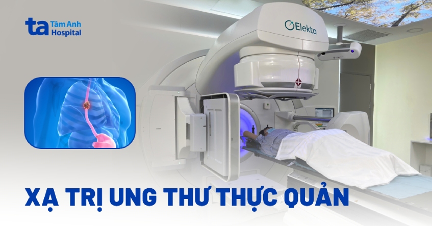 Thông tin về phương pháp xạ trị ung thư thực quản