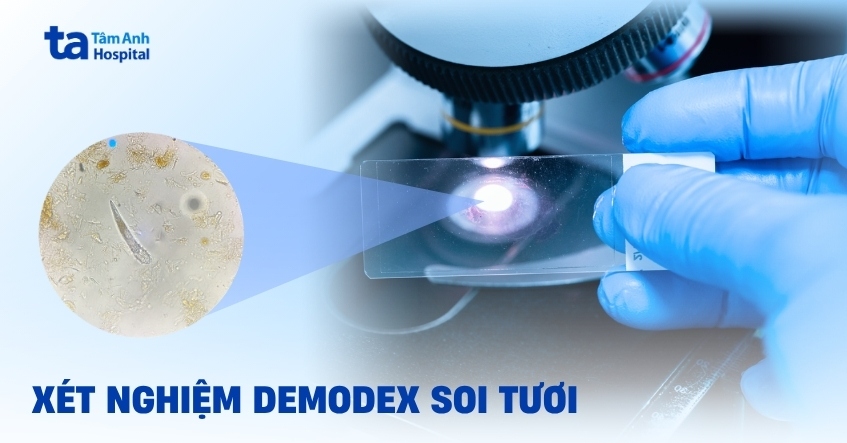 Quy trình xét nghiệm Demodex soi tươi có ý nghĩa gì?