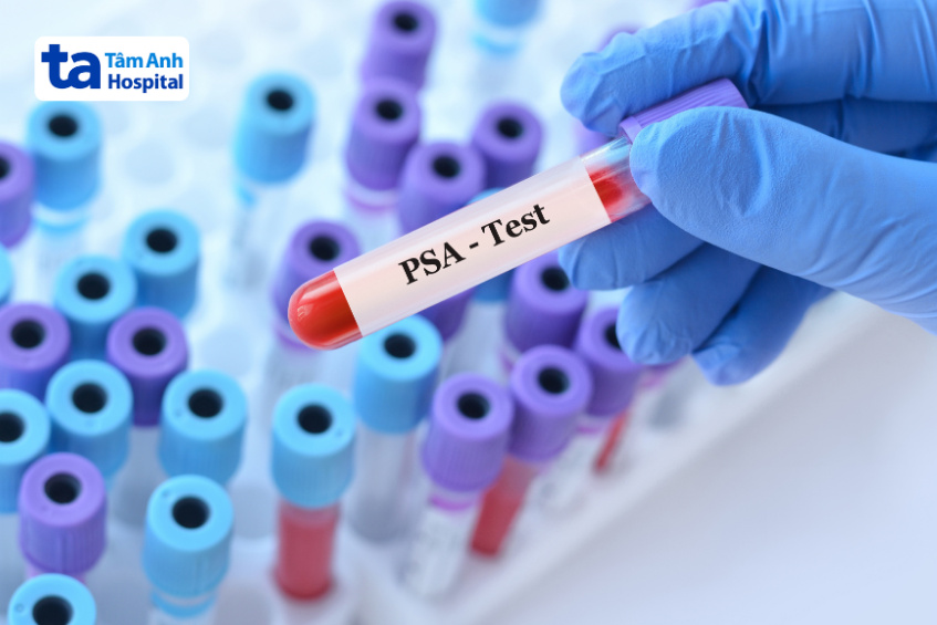 xét nghiệm psa test