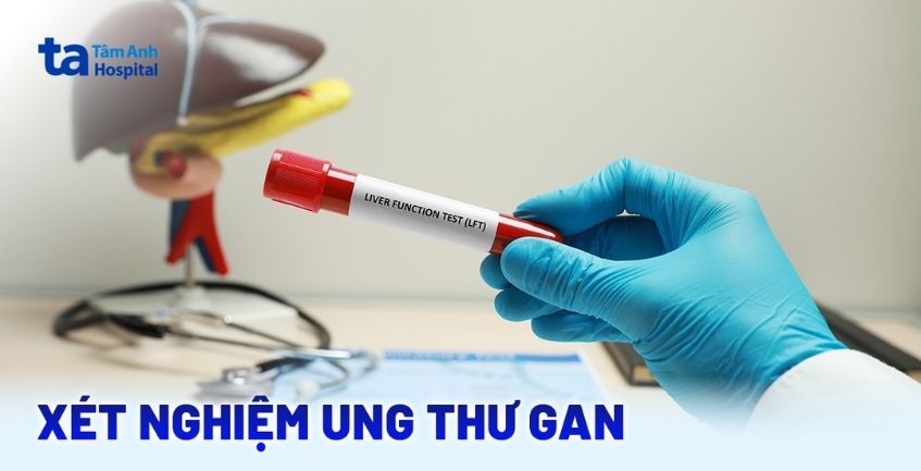 Xét nghiệm ung thư gan: Khi nào chỉ định thực hiện?