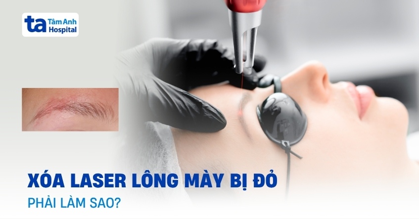 Vì sao xóa laser lông mày bị đỏ? Đâu là giải pháp?