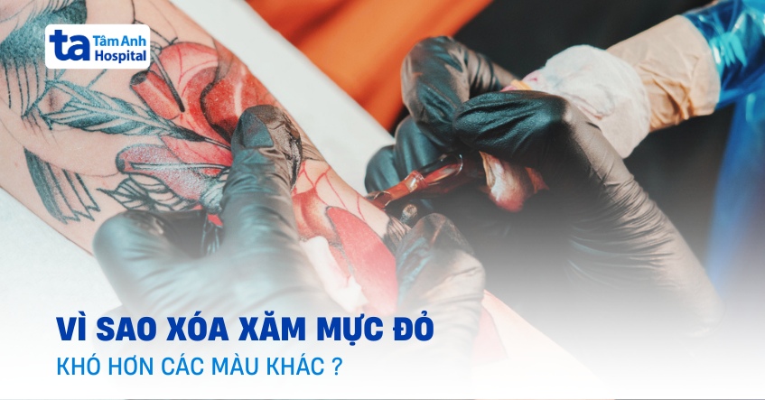 Có khả năng xóa xăm mực đỏ được không?