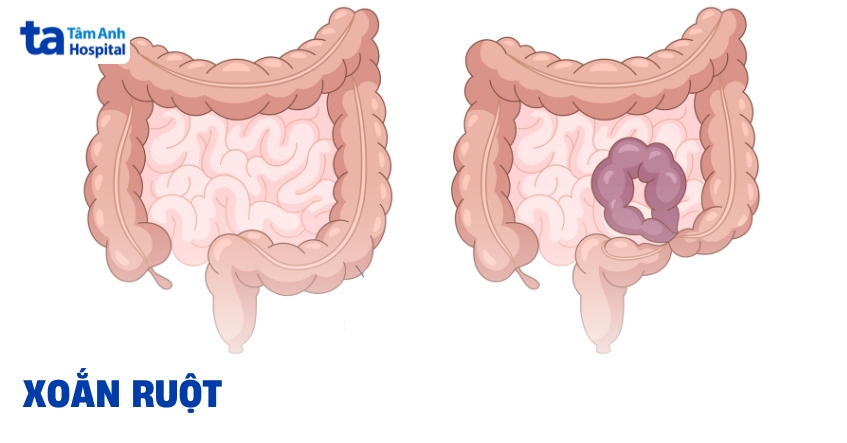 Xoắn ruột là tình trạng gì? Do đâu gây ra?