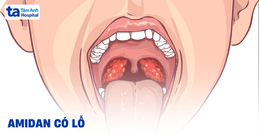 Tại sao Amidan có lỗ? Tình trạng này có đáng lo ngại?