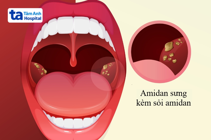 amidan sưng kèm sỏi amidan