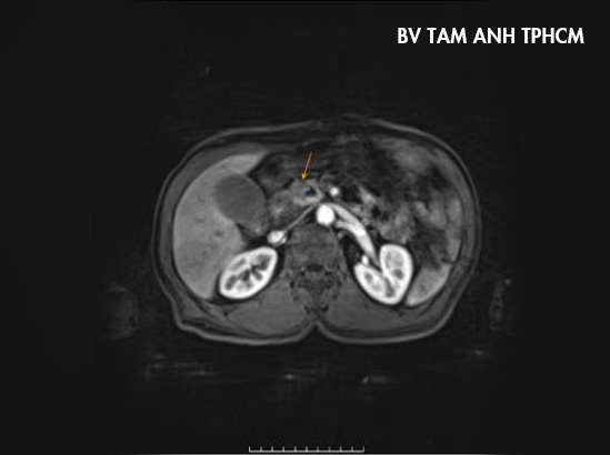 ảnh CT ghi nhận tổn thương đầu tụy
