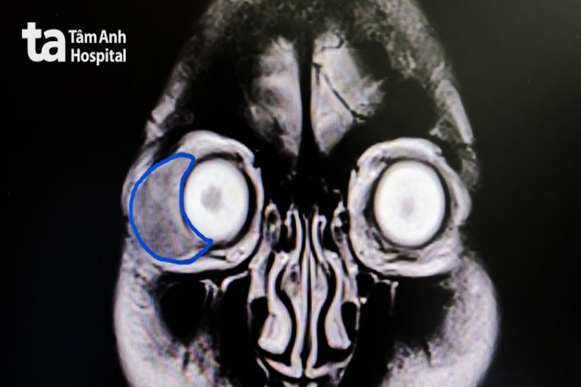 ảnh ct vùng mặt bệnh nhân