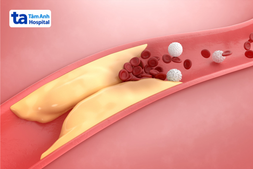 ảnh minh họa lòng động mạch bị hẹp do các mảng xơ vữa tích tụ