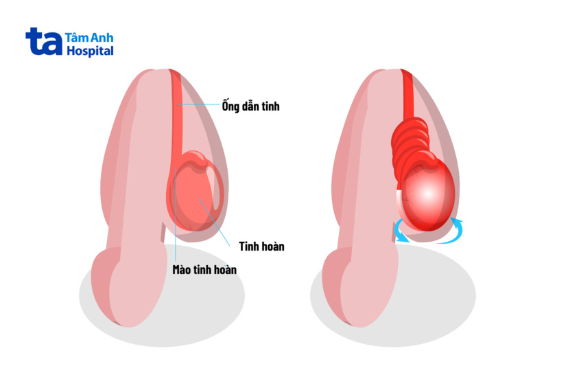 ảnh minh họa xoắn tinh hoàn