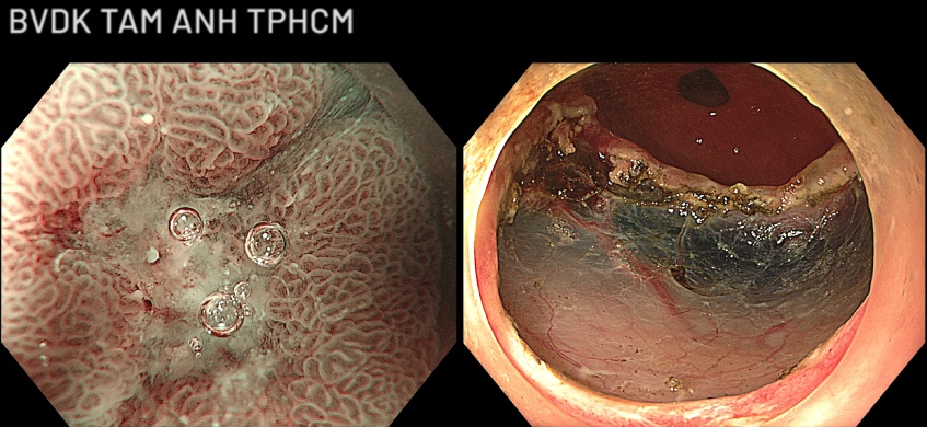 ảnh nội soi cấu trúc mạch máu