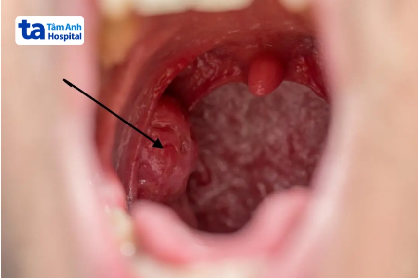 bề mặt của amidan