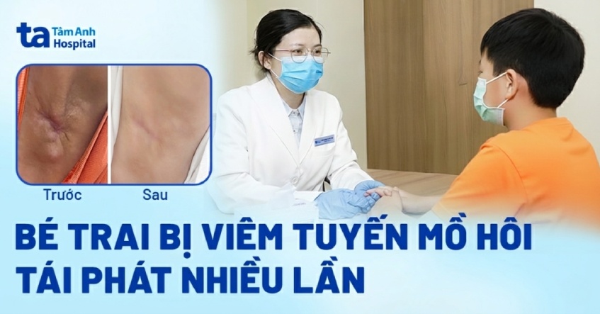 Bé trai bị viêm tuyến mồ hôi tái phát nhiều lần