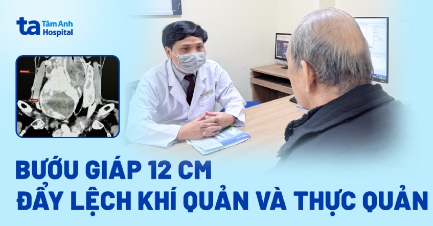 Bướu giáp 12 cm đẩy lệch khí quản và thực quản