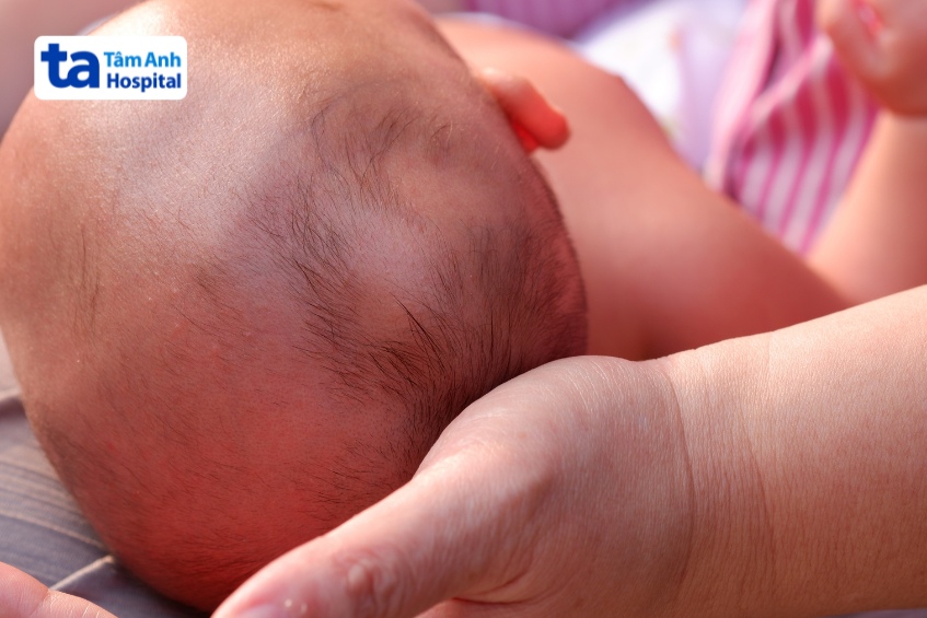 bướu huyết thanh có thể gây rụng tóc tạm thời ở vị trí xuất hiện