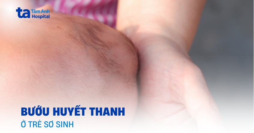 Bướu huyết thanh ở trẻ sơ sinh bao lâu thì hết?