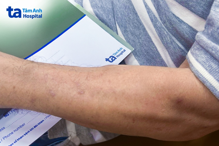 các tổn thương da của anh phát giảm rõ, hết ngứa sau 3 tháng điều trị