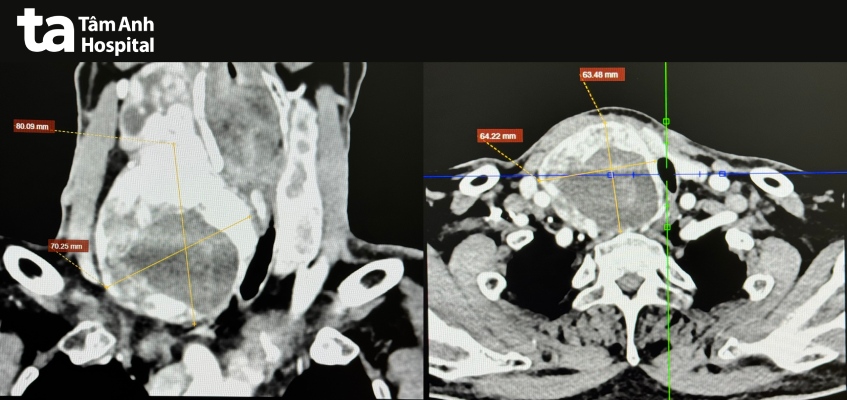 Ảnh chụp CT cho thấy bướu giáp kích thước lớn, chèn ép khí quản