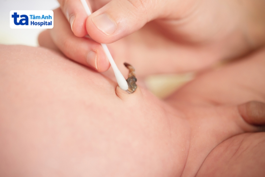 cuống rốn trẻ sơ sinh sắp rụng