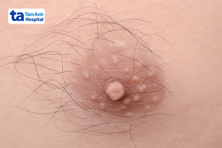 đặc điểm nhận diện lông mọc quanh núm vú