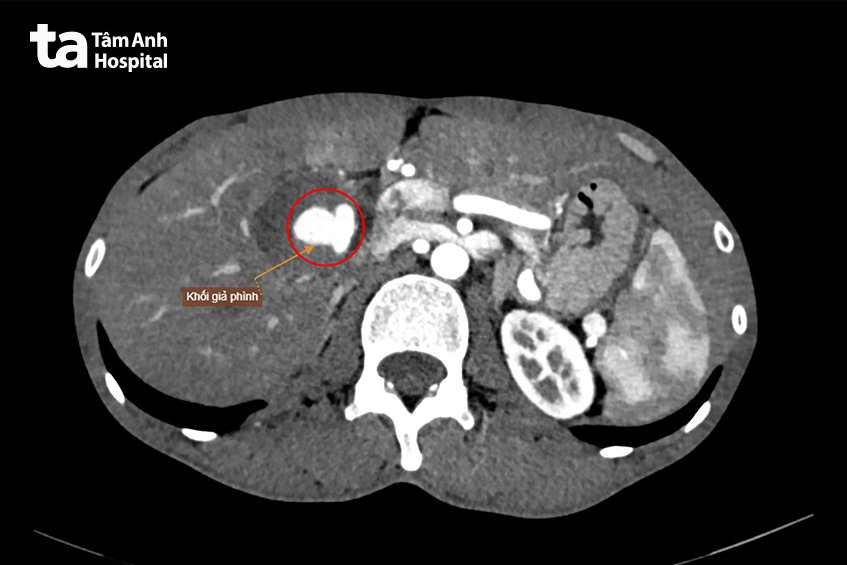 Khối giả phình lớn nguy cơ vỡ trên hình chụp CT Scan. Ảnh: Bệnh viện đa khoa Tâm Anh