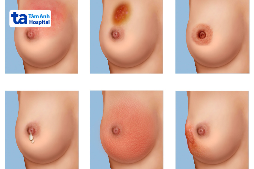 dấu hiệu nhũ hoa không khỏe mạnh