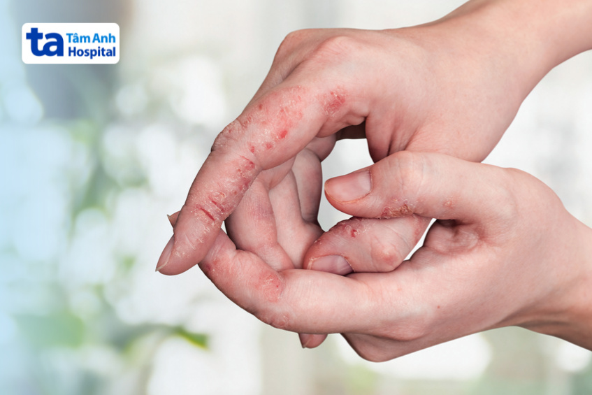 dấu hiệu viêm da đầu chi ruột