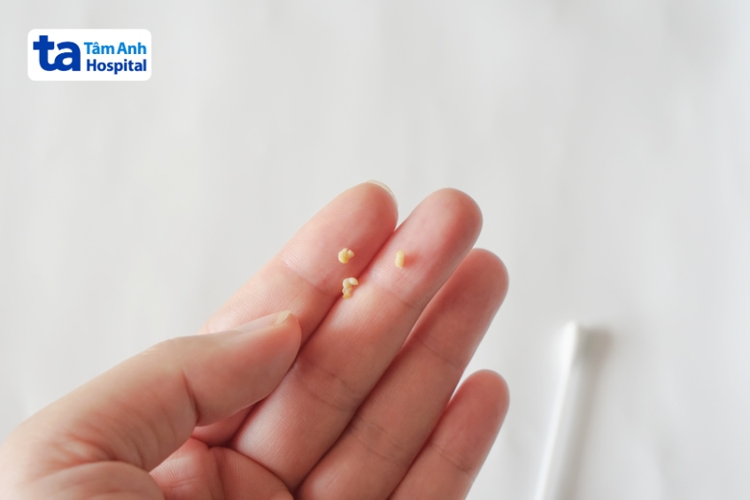 đây là sỏi amidan