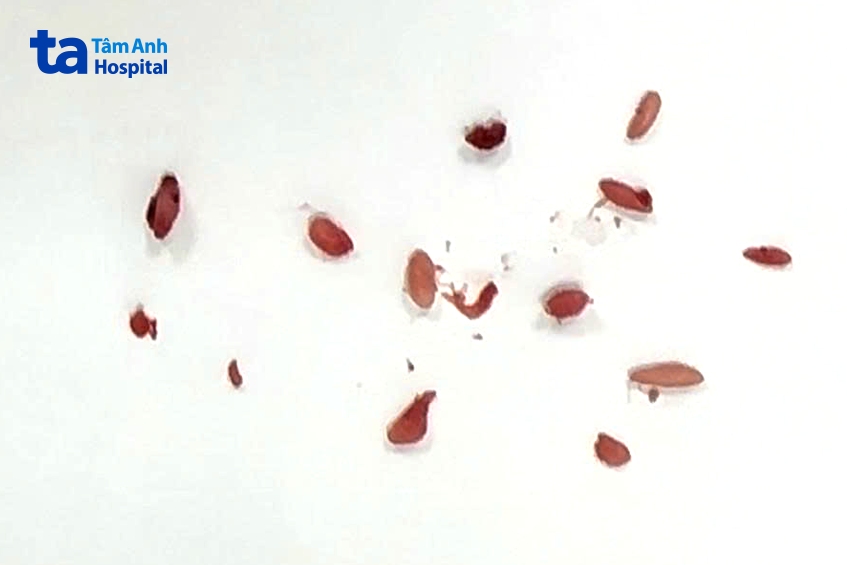 dị vật lấy ra từ trán người bệnh