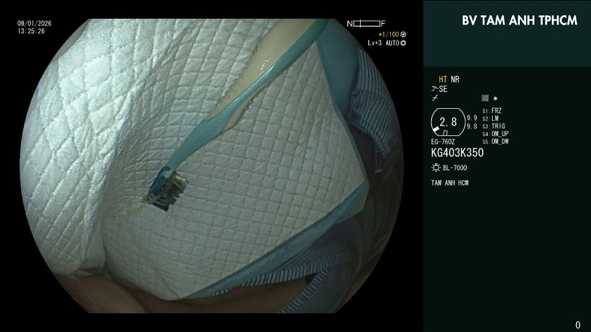 dị vật trong dạ dày