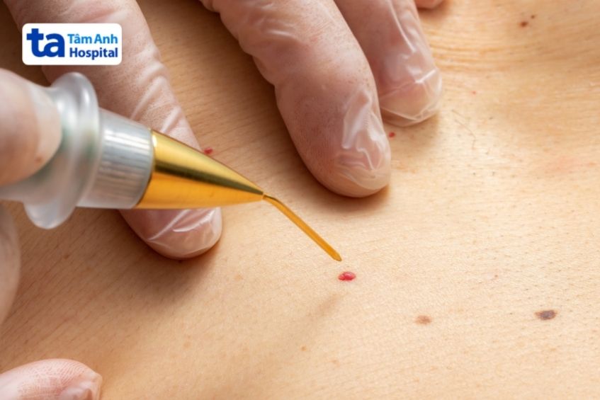 điều trị u máu