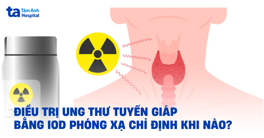 Điều trị ung thư tuyến giáp bằng iod phóng xạ
